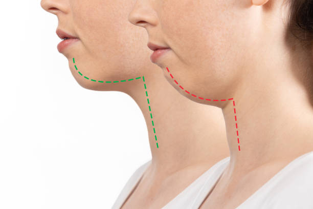 Tratamento: Cirurgia ortognática