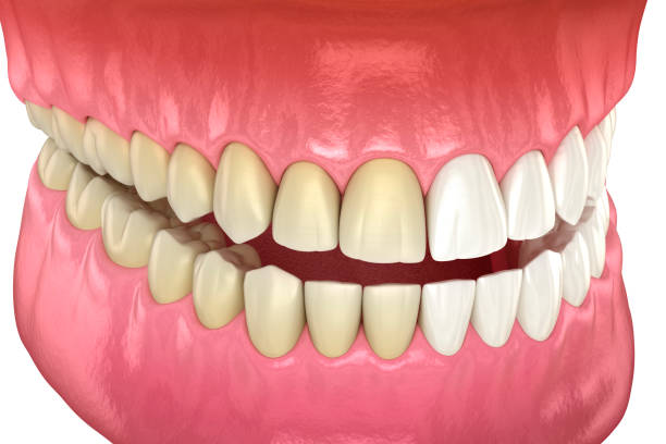 Tratamento: Clareamento dental