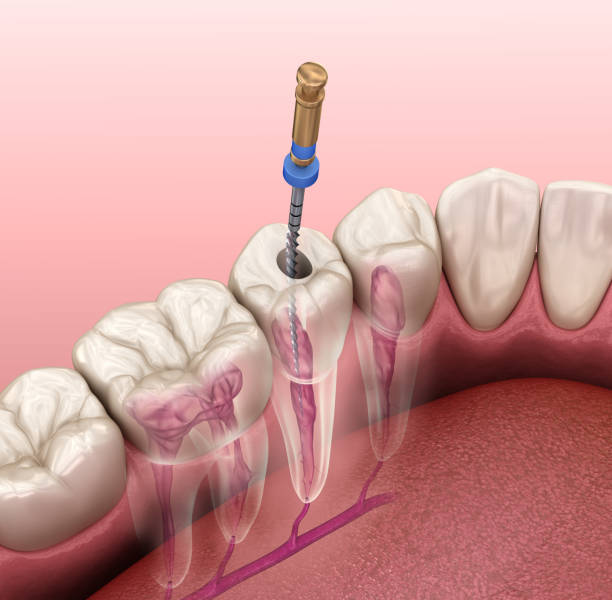 Tratamento: Endodontia