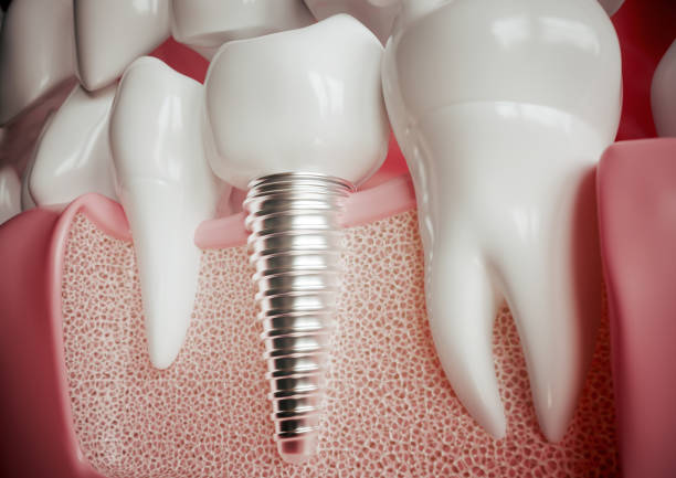 Tratamento: Implantes