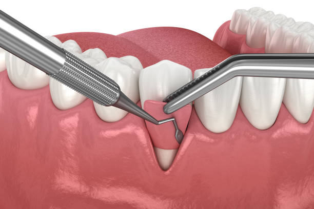 Tratamento: Periodontia